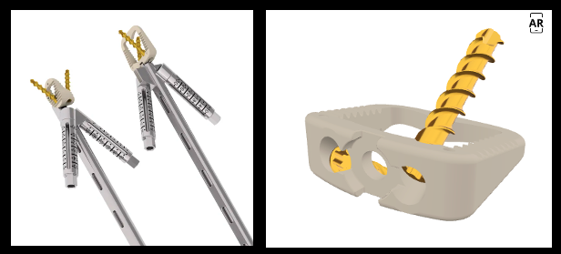 trigon® Osteotomy Wedge System (Prod 2406211)